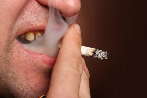 牙齒美白貼片：重現您燦爛的笑容